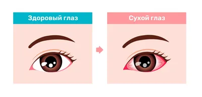 Синдром сухого глаза — симптомы, причины, диагностика, лечение