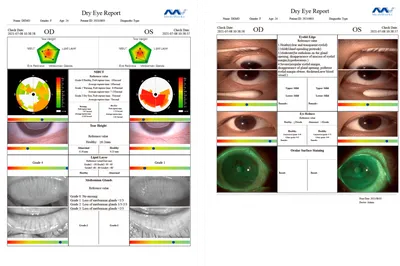 Синдром сухого глаза - причины сухости, симптомы, лечение