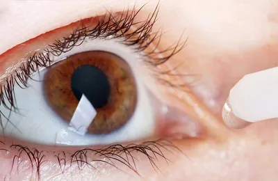 Синдром сухого глаза лечение в Москве