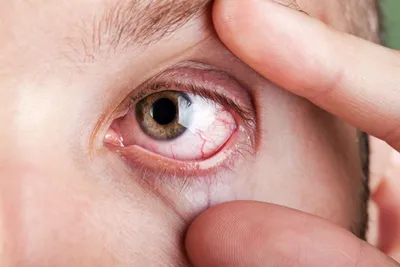 Синдром сухого глаза - симптомы и лечение