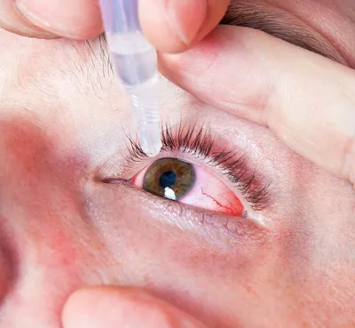 Офтальмологические тест-полоски для определения синдрома сухого глаза (тест  Ширмера)