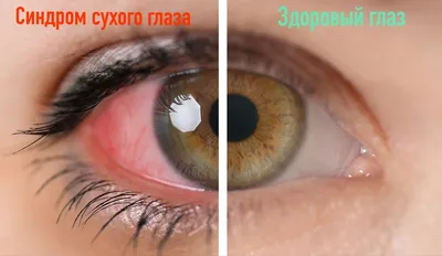 Сухой глаз: лечение, препараты | Причины сухости в глазах | Клиника Санта
