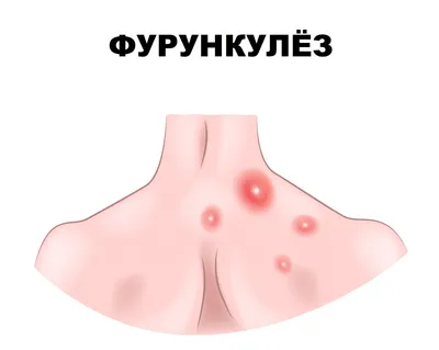 Лечение атопического дерматита - MedicalAdvice.ru