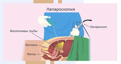 Спаечный процесс в малом тазу: лечение, диагностика в Москве в клинике  АльтраВита