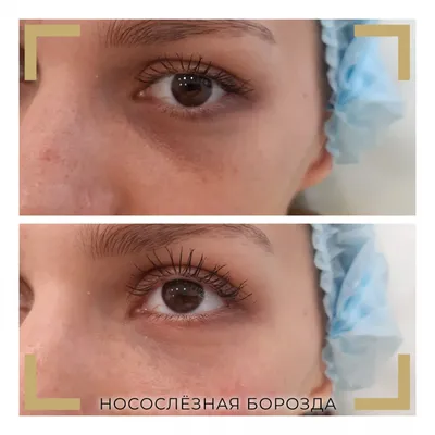 cosmetolog_ses_ - 💧Малярные мешки под глазами(суфы )... | Facebook