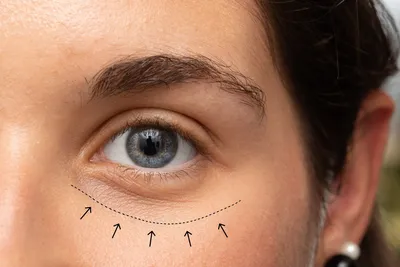 Как убрать синяки под глазами? | Израильская косметики Anna Lotan | Дзен