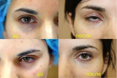 Как правильно замаскировать синяки под глазами с помощью макияжа: пошаговая  инструкция - Афиша bigmir)net