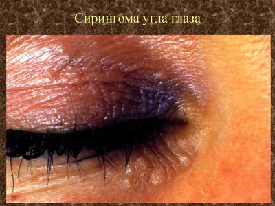 Удалить милиум в Воронеже - лучшая косметологическая процедура для век,  цена | ЛЕМАРК