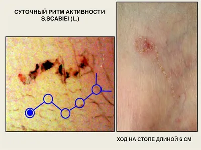 Кожное заболевание чесотка - презентация онлайн