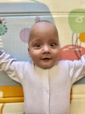 Кузбасские нейрохирурги заново собрали череп годовалому малышу с редким  диагнозом