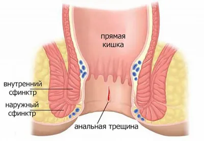 Анальные трещины: причины, симптомы и лечение