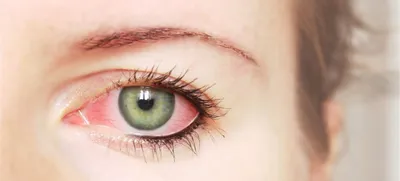 Склерит глаза - причины, симптомы, диагностика, лечение и профилактика