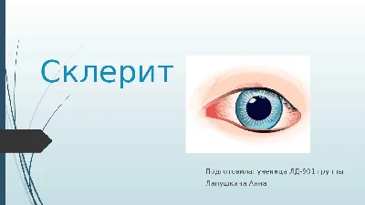 Воспаления глаза, склерит, эписклерит - причины, симптомы, лечение