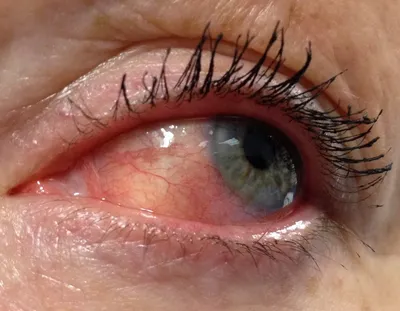 Склерит глаза - лечение, причины, симптомы