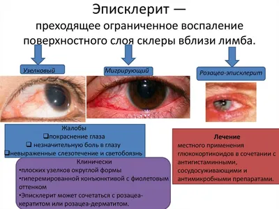 Рис. 1. Некротический склерит на фоне гланулематоза с полиангиитом