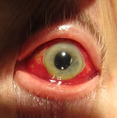 Склерит глаз — это воспалительное заболевание склеры • Новий Зір