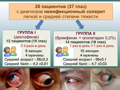 Красные глаза: в чем причина? статья на сайте halvaoptik.by | Halvaoptik.by