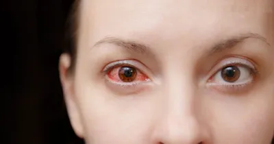 Склерит глаза - причины, симптомы и лечение - YouTube