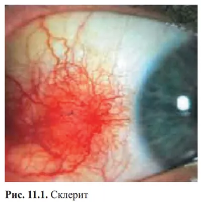 Врач рассказал, что такое синдром красного глаза и как помочь — ТСН,  новости 1+1 — Здоровый образ жизни