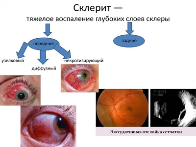 Соты в склере глаз ,вокруг пчелы ,…» — создано в Шедевруме