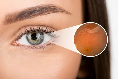 Киста конъюнктивы глаза: что это такое, как ее распознать и лечить | Первая  глазная клиника в Москве | Дзен