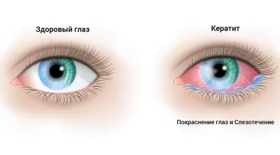 Покраснение глаз: что делать, причины, лечение у взрослых и детей