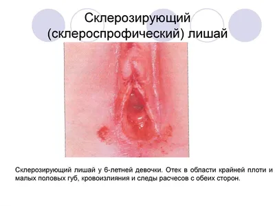 ПРАКТИКА] КЛИНИЦИСТЫ НЕДОСТАТОЧНО ЛЕЧАТ СКЛЕРОАТРОФИЧЕСКИЙ ЛИХЕН У ДЕТЕЙ На  ежегодном собрании Американского.. | ВКонтакте