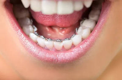 Брекеты на нижние зубы - Cтоматология Май