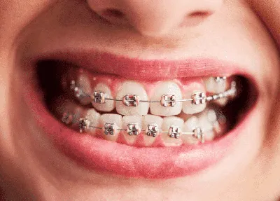 Ортодонтические скобы на зубы в Москве - доступные цены