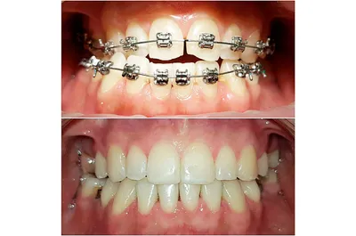 Брекеты в Курске: установка брекетов в стоматологии Doctor Smile