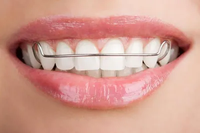 Брекеты: стоимость в Москве на установку системы под ключ на обе челюсти в  клинике стоматологии