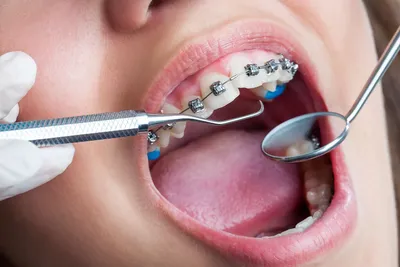 Скобы для зубов: конструкция, показания и противопоказания к использованию