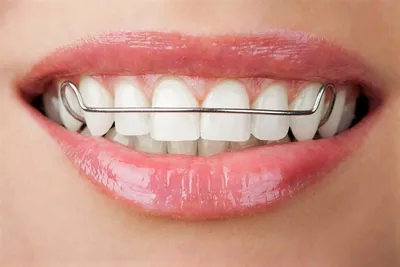 Брекеты на зубы – ставить или нет? Ответы на самые распространенные вопросы.