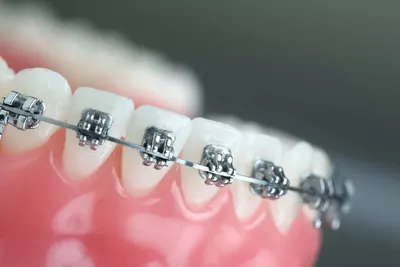 Ортодонтия - Стоматологическая Клиника DijiDent