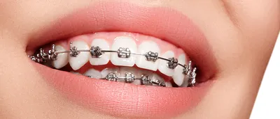 Металлические брекеты: цена в Москве в стоматологии Империя