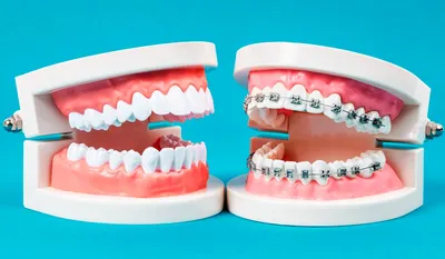 Пластинки для зубов. — Стоматология МедМар