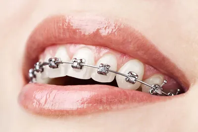 Брекеты для зубов — то, с помощью чего можно исправить неправильный прикус