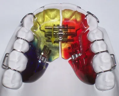 Скобы для зубов, как исправить прикус | Стоматология \"Имплант-Эксперт\" |  Дзен