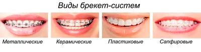 Акция на ортодонтическое лечение брекетами в Новосибирске