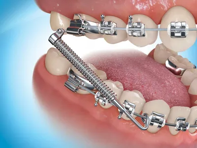 Пластинки для зубов. — Стоматология МедМар