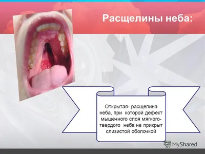 Расщелина неба («волчья пасть») и здоровье зубов ребенка