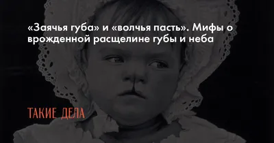 Презентация на тему: \"Врожденные расщелины мягкого неба. Сабмукозная Полная  Неполная Сабмукозная Полная Неполная Односторонняя Двухсторонняя  Односторонняя Двухсторонняя.\". Скачать бесплатно и без регистрации.