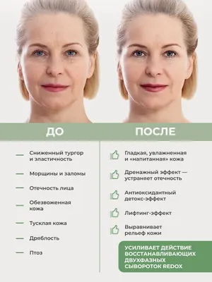 Скульптра (Sculptra). Отзывы косметологов. | Tori Clinic | Дзен