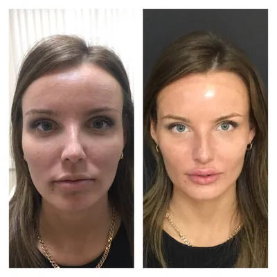 Аппаратная косметология - фото до и после, цены в клинике СПИК
