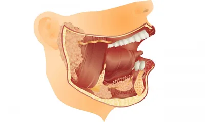 Слюннокаменная болезнь в полости рта