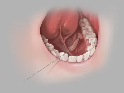 Слюннокаменная болезнь –... - Стоматологическая поликлиника 8 | Facebook