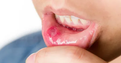 Болезни твердых тканей зуба