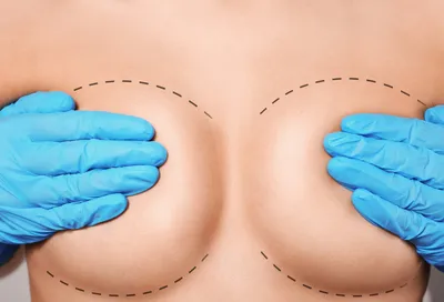 Реабилитация после маммопластики: правила ухода после пластики груди | блог  Gold Laser