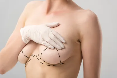 Дабл бабл груди после маммопластики: коррекция двойной груди, что это такое