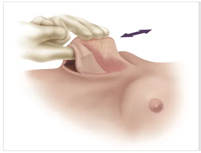 Риски и осложнения при увеличении груди | Александр Маркушин пластический  хирург